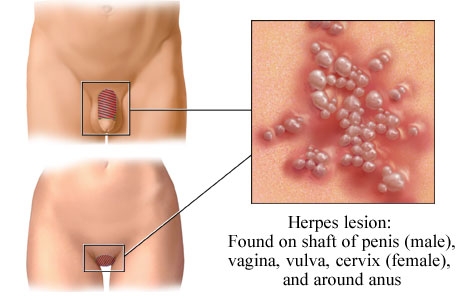 Herpes genital